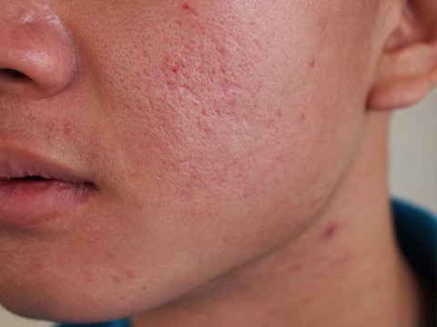 Home 54 Dermatologist recommended For daily use Oil-free formula-before