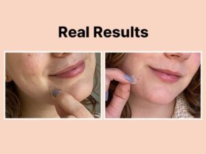 COSRX Acne Pimple Master Patch 24 Patches — Spot Treatment