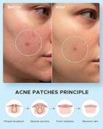COSRX Acne Pimple Master Patch 24 Patches — Spot Treatment