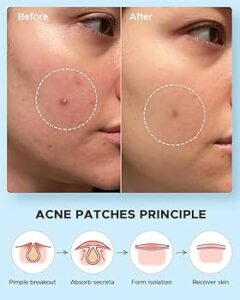COSRX Acne Pimple Master Patch 24 Patches — Spot Treatment