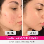 COSRX Acne Pimple Master Patch 24 Patches — Spot Treatment