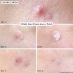 COSRX Acne Pimple Master Patch 24 Patches — Spot Treatment